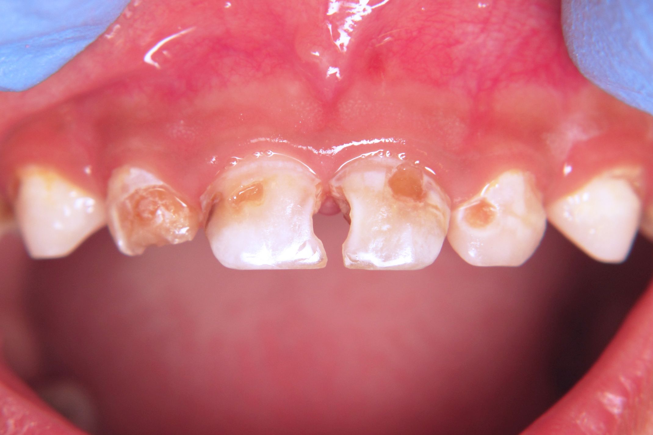 Early Childhood Caries (ECC) • SA Dental